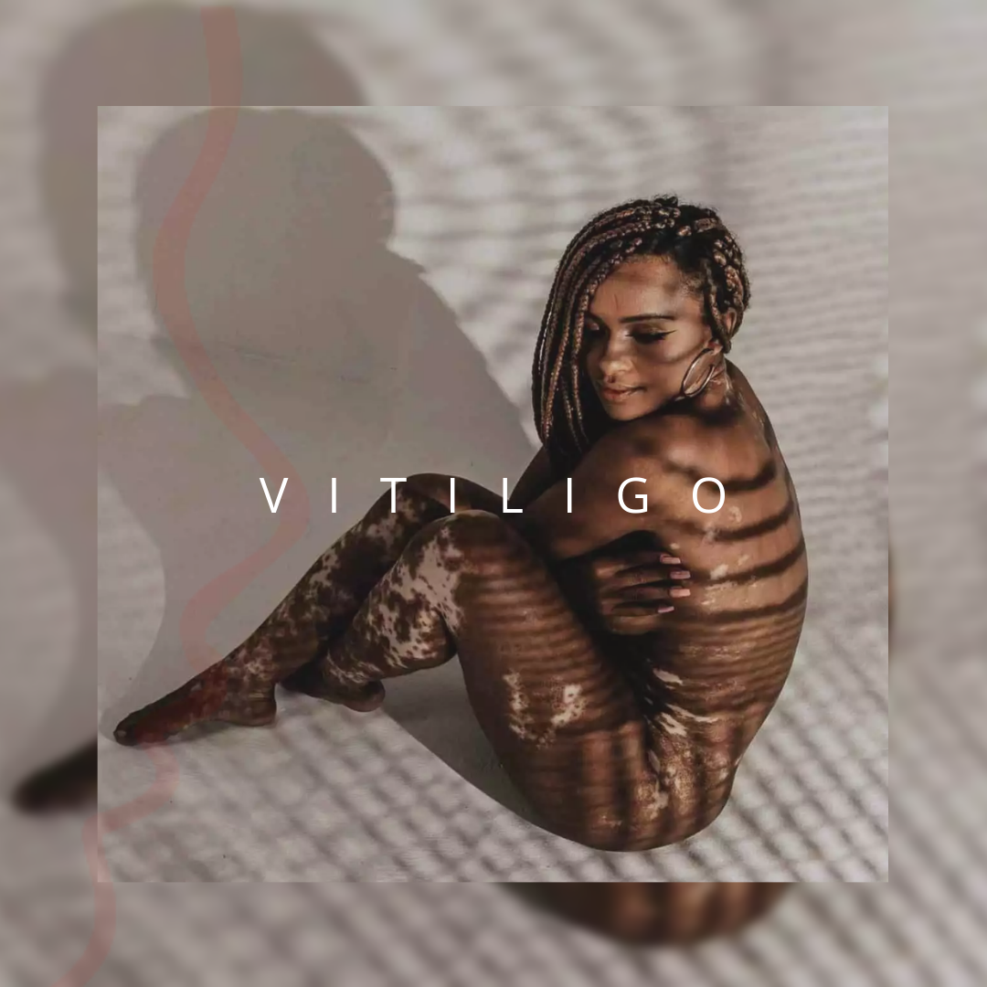 vitiligo_post